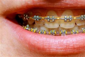 Colores de brackets para hombres