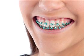 Colores de brackets para mujer