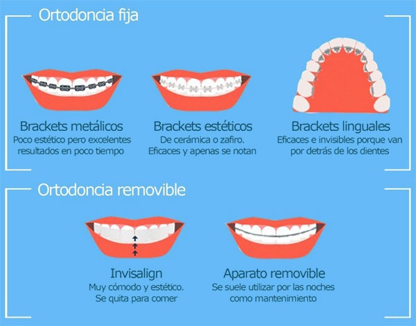 Tipos de Ortodoncia o brackets