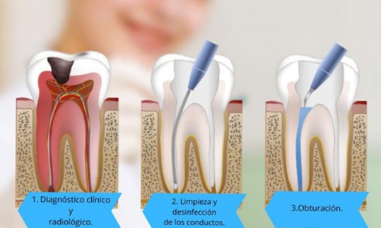 Endodoncia - Tratamiento de Conductos en Bogotá