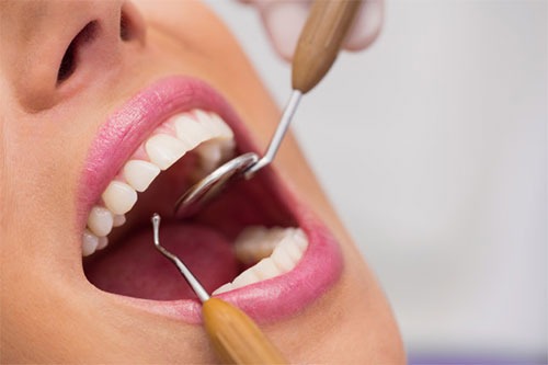 Endodoncia - Tratamiento de Conductos en Bogotá