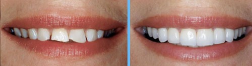 Diseño de sonrisa con carillas directas (Bonding Veneers):