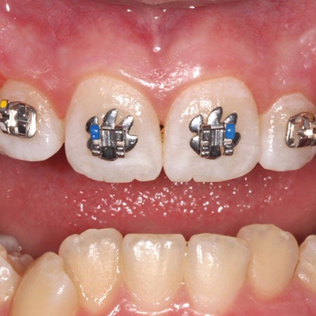 Brackets con figuras