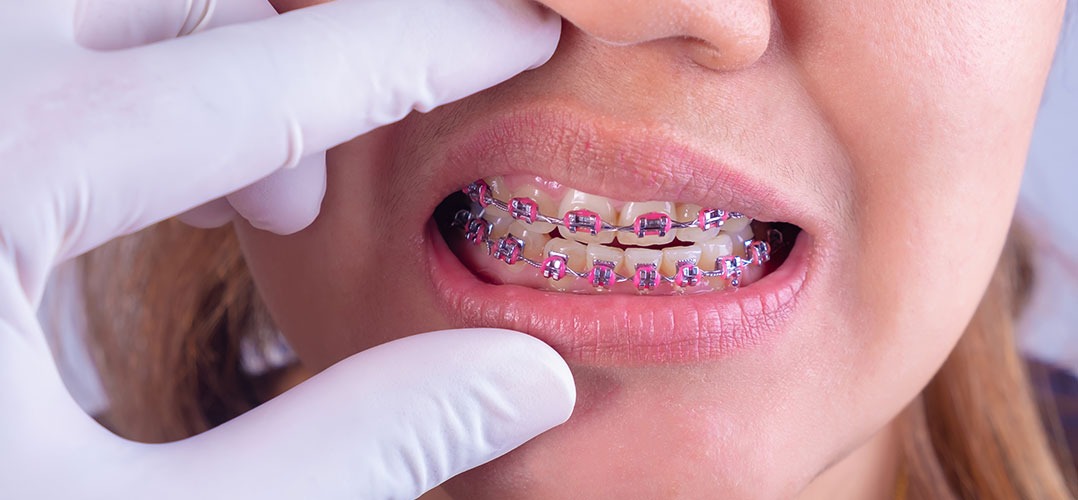 Tips para elegir colores de brackets