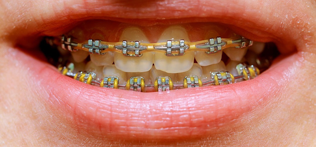 Colores de brackets para hombres